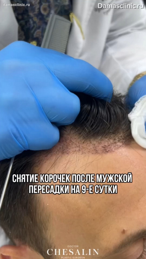 Пересадка волос с перевязкой и снятием корочек черед девять дней после трансплантации. Видео осмотра