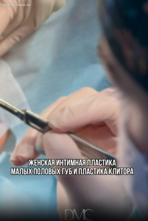 Комплексная лабиопластика с пластикой малых половых губ и пластикой клитора: до и через 4 недели после с фото-результатами