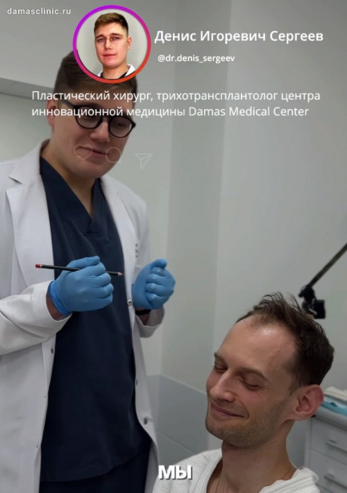 Мужская пересадка волос методом FUE в процессе и с фото результатом сразу после