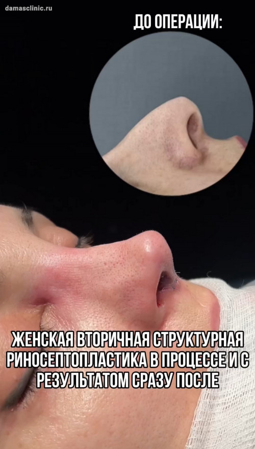 Женская структурная риносептопластика в процессе и видео-результат сразу после
