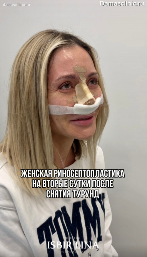 Как снимаются турунды. Что такое дышащие турунды. Видео процесса снятия турунд с комментариями