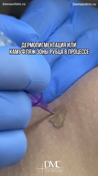 Что такое дермопигментация или камуфляж швов