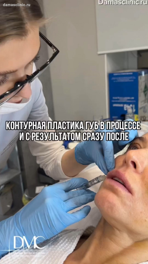 Контурная пластика губ в процессе и с результатом сразу после. Показания и противопоказания к увеличению губ