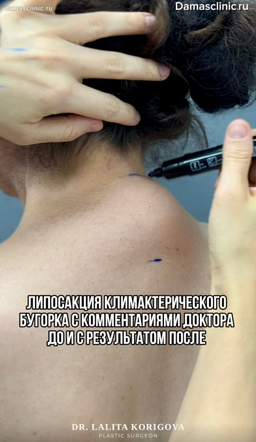 Липосакция климактерического бугорка с комментариями доктора до и с фото результатом после