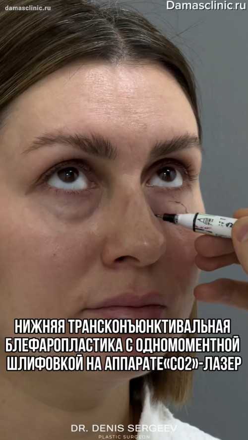 Нижняя трансконъюнктивальная блефаропластика с одномоментной шлифовкой век на аппарате «CO2»-лазер