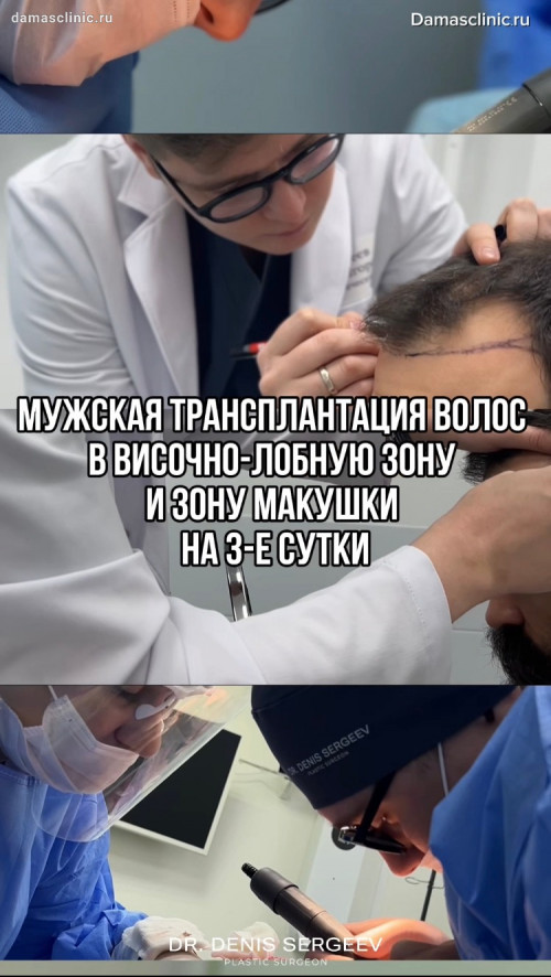 Мужская трансплантация волос в височно-лобную зону и зону макушки на 3-и сутки с фото- и видео-результатом
