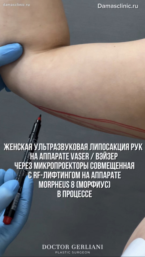 Женская ультразвуковая липосакция рук на аппарате VASER / ВЭЙЗЕР через микропроколы, совмещенная с RF-лифтингом на аппарате MORPHEUS 8 (МОРФИУС), в процессе