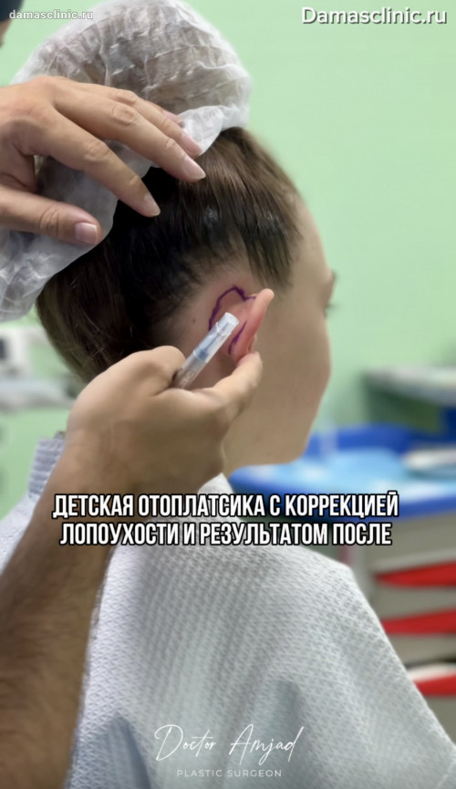 Детская отопластика для девочки с коррекцией лопоухости с видео- и фото-результатами