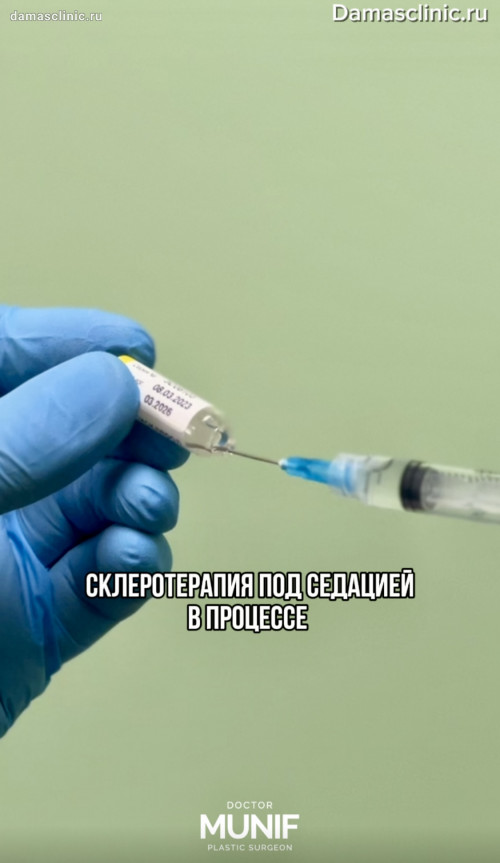 Склеротерапия под седацией в процессе. Показания и противопоказания к склеротерапии. Фото результатов