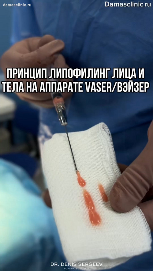 Принцип липофилинга лица и тела на аппарате VASER / ВЭЙЗЕР с комментариями доктора