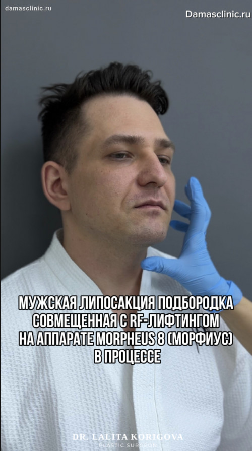 Мужская липосакция подбородка, совмещенная с RF-лифтингом на аппарате MORPHEUS 8 (МОРФИУС), в процессе