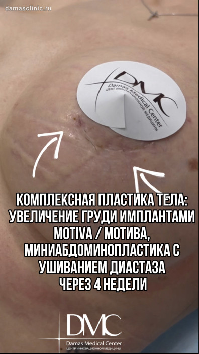 Комплексная пластика тела: увеличение груди имплантами MOTIVA / МОТИВА, миниабдоминопластика с ушиванием диастаза через 4 недели (видео-результат)