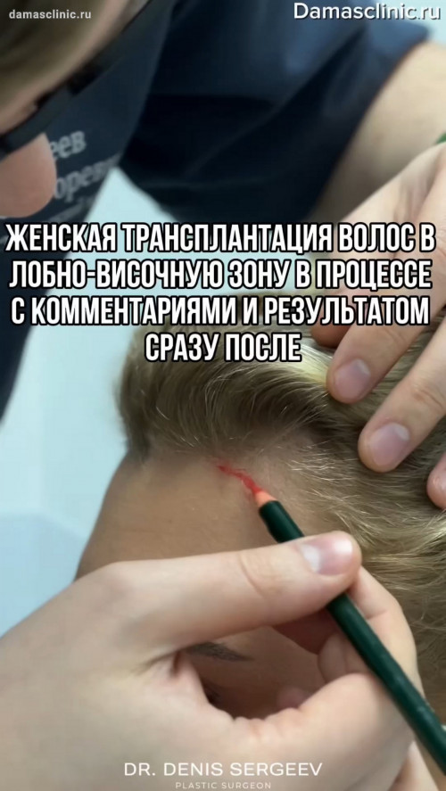 Женская трансплантация волос в лобно-височную зону методом HFE в процессе с комментариями и результатом сразу после