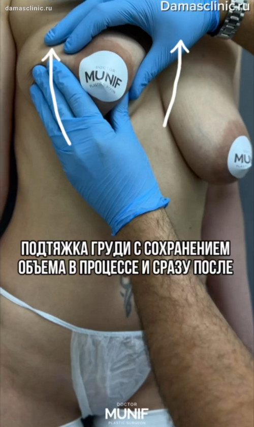 Подтяжка груди с сохранением объема в процессе и сразу после с видео-результатом