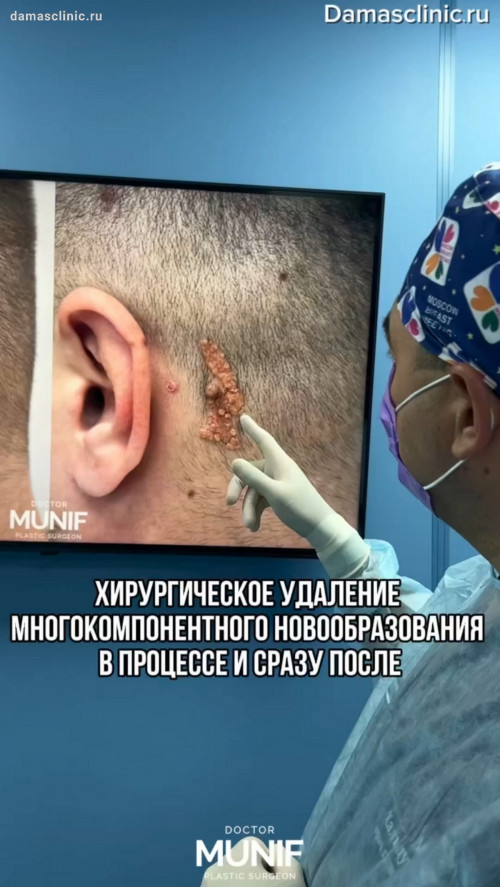 Хирургическое удаление липомы и новообразований: фото до и сразу после