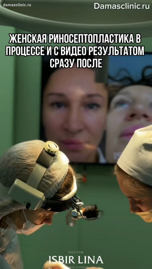 Вторичная риносептопластика с забором реберного хряща: до и сразу после (с видео-результатом)
