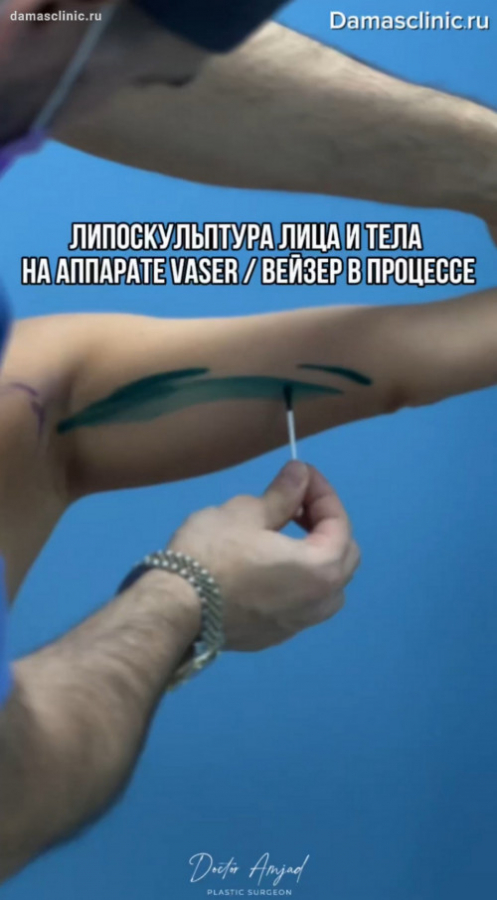 Липоскульптура лица и тела на аппарате VASER / ВЕЙЗЕР в процессе