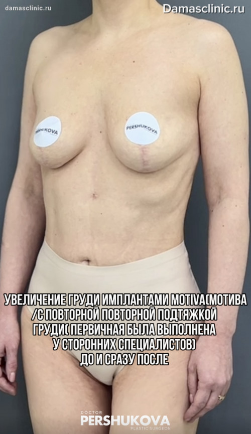 Якорная подтяжка груди повторно с реэндопротезированием имплантами MOTIVA / МОТИВА: до и через 4 недели после (первая операция проводилась у сторонних специалистов) с фото-результатами