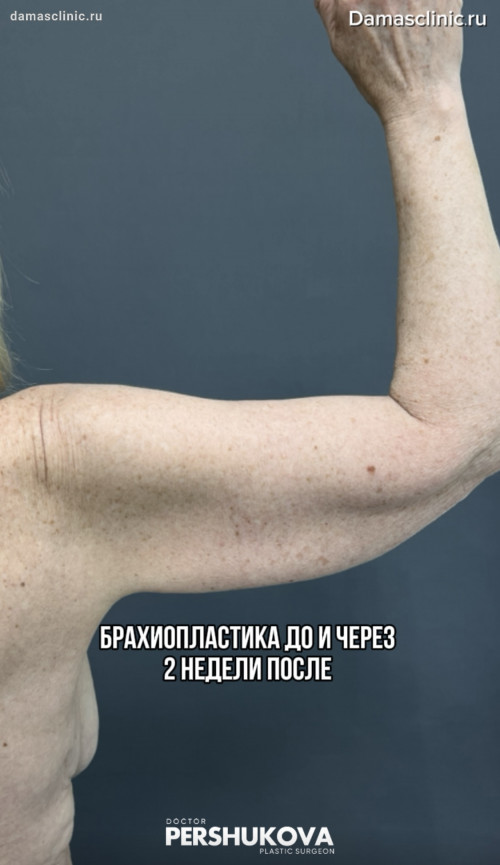 Брахиопластика: до и через 2 недели после (с фото-результатами)