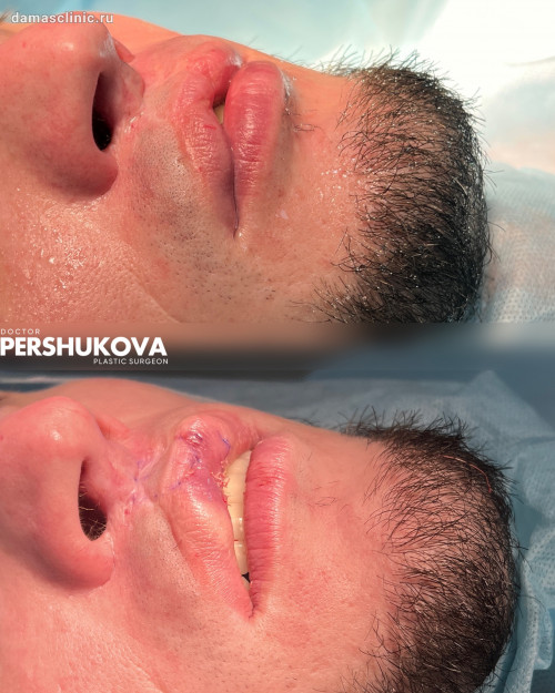 Мужская реконструкция дефекта «заячья губа» с комментариями в процессе и с результатом после