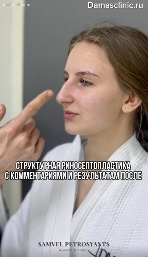 Структурная риносептопластика с комментариями и фото-результатом после