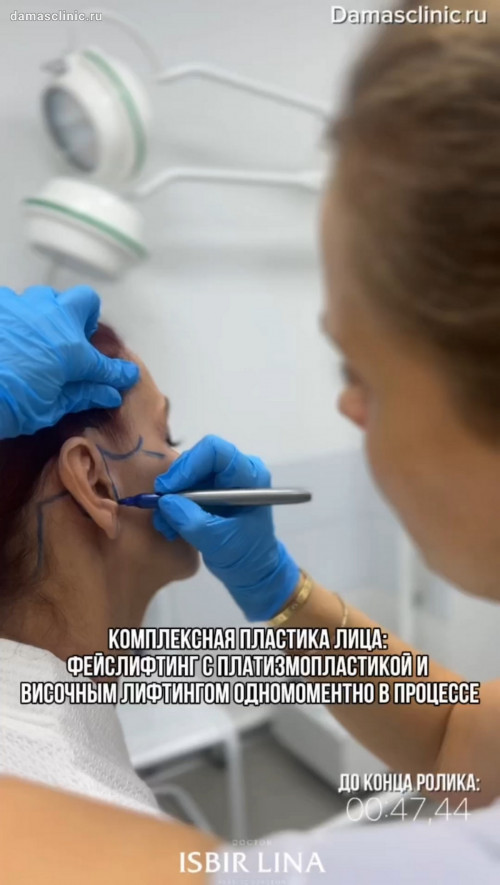 Комплексная пластика лица: фейслифтинг с платизмопластикой и височным лифтингом одномоментно в процессе 