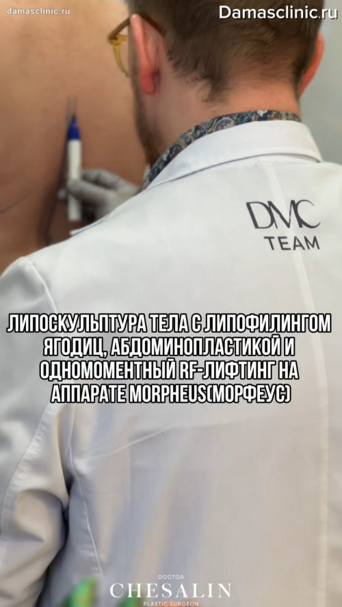 Липоскульптура тела с липофилингом ягодиц, абдоминопластикой и одномоментный RF-лифтинг на аппарате MORPHEUS (МОРФЕУС) с видео