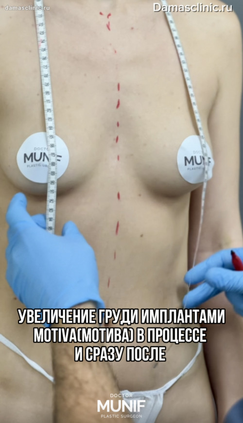 Увеличение груди имплантами Motiva (Мотива): в процессе и сразу после (с видео-результатом)