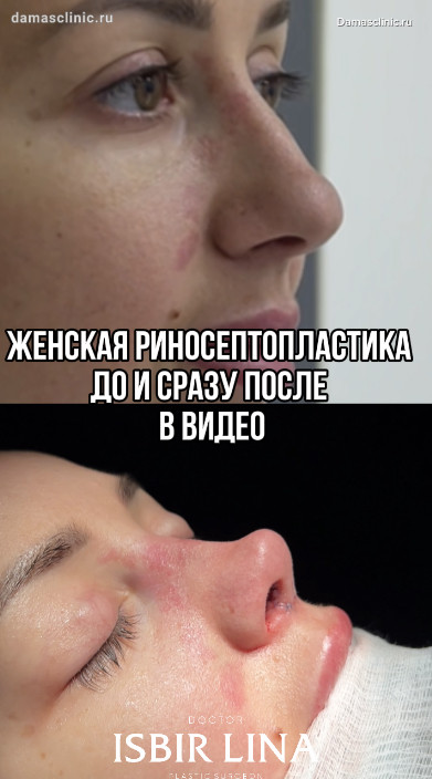 Как выглядит нос сразу после риносептопластики в видео