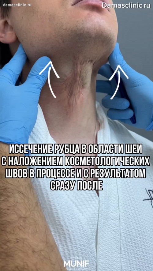 Иссечение рубца в области шеи с наложением косметических швов в процессе и с результатом сразу после в фото