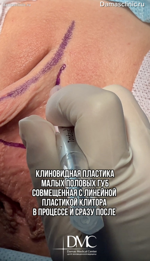Клиновидная пластика малых половых губ, совмещенная с пластикой клитора, в процессе и сразу после с фото- и видео-результатом