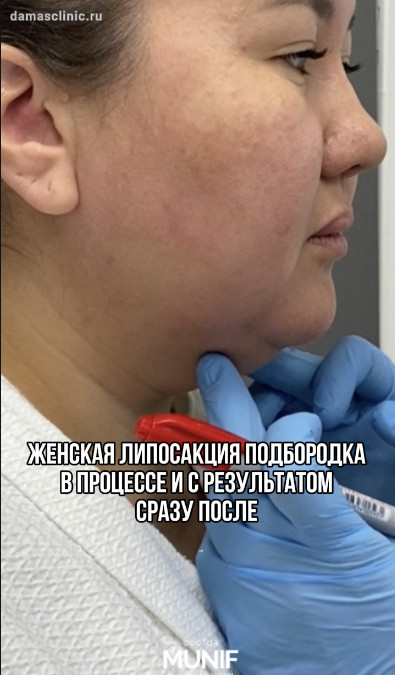 Женская липосакция подбородка в процессе и с результатом сразу после с фото и видео