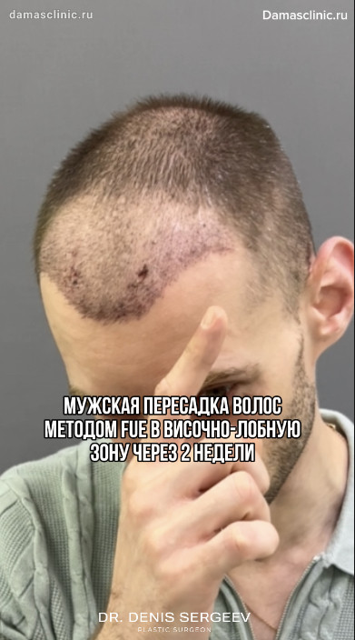 Мужская пересадка волос методом FUE в височно-лобную зону: до и через 2 недели с видео-результатом