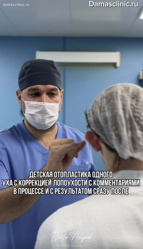 Детская отопластика одного уха с коррекцией лопоухости для мальчика в процессе, с фото- и видео-результатами на осмотрах