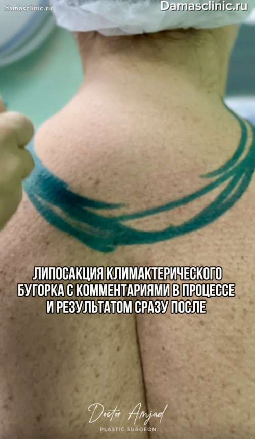 Удаление «вдовьего горба» или климактерического бугорка в процессе и с фото- и видео-результатами