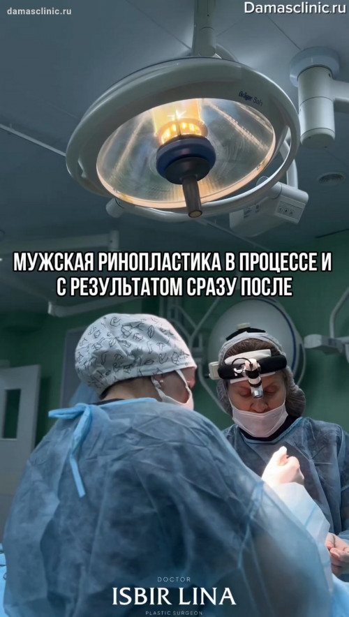Мужская ринопластика в процессе и с видео-результатом сразу после