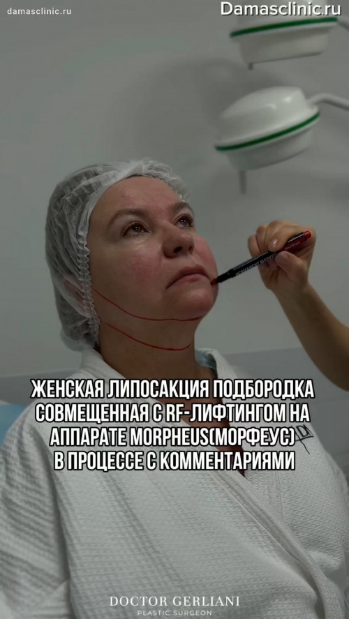 Женская липосакция подбородка, совмещенная с RF-лифтингом на аппарате MORPHEUS (МОРФЕУС): в процессе с комментариями в видео