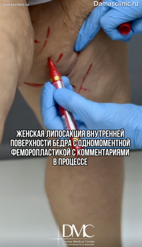 Женская липосакция внутренней поверхности бедра с одномоментной феморопластикой с комментариями в процессе