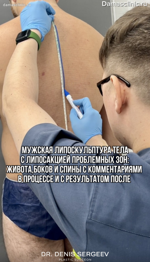 Мужская липоскульптура тела с липосакцией проблемных зон (живота, боков и спины) с комментариями в процессе и с результатом после