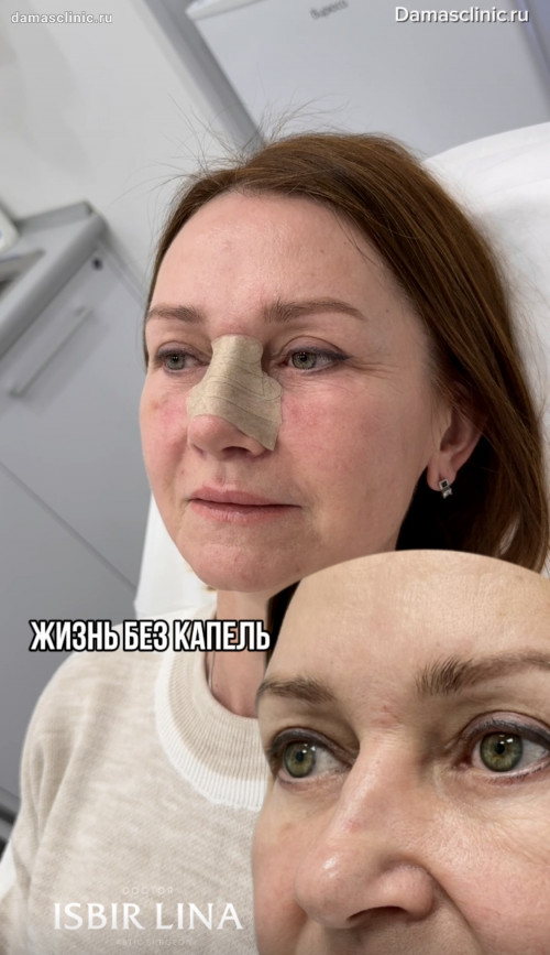 Жизнь без капель для носа. Отзыв пациентки на 11-е сутки