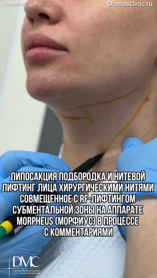 Липосакция подбородка и нитевой лифтинг лица хирургическими нитями с RF-лифтингом субментальной зоны на аппарате MORPHEUS (МОРФИУС) в процессе с комментариями