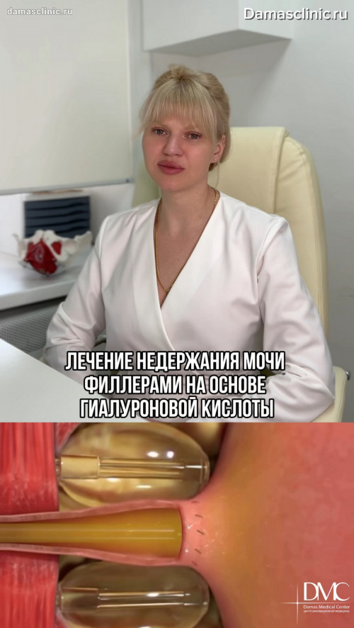 Какие результаты дает интимное RF- омоложение и сужение влагалища на аппарате MORPHEUS 8. Комментарий доктора