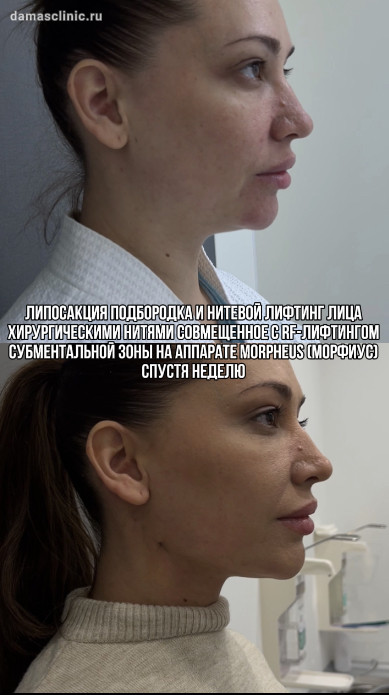 Липосакция подбородка и нитевой лифтинг лица хирургическими нитями, совмещенные с RF-лифтингом субментальной зоны на аппарате MORPHEUS (МОРФИУС), спустя неделю