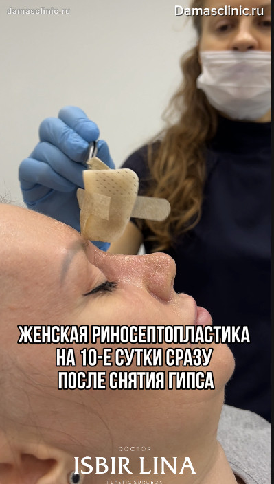 Женская риносептопластика на 10-е сутки, сразу после снятия гипса