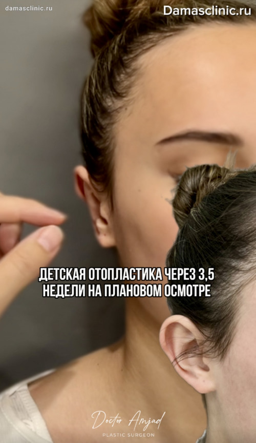 Вид наркоза при детской отопластике с коррекцией лопоухости. Фото и видео результатов на осмотрах