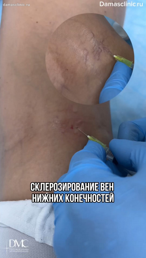 Склерозирование вен нижних конечностей в процессе с комментариями доктора