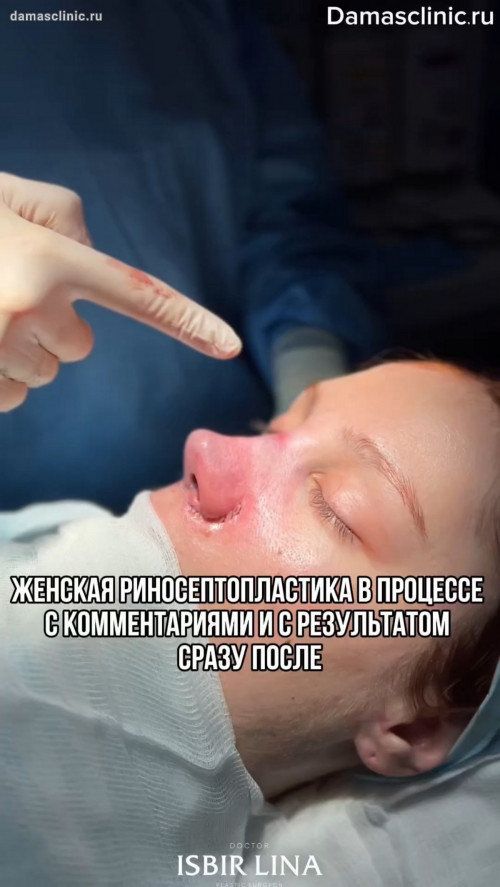 Женская риносептопластика в процессе с комментариями и с результатом сразу после в видео