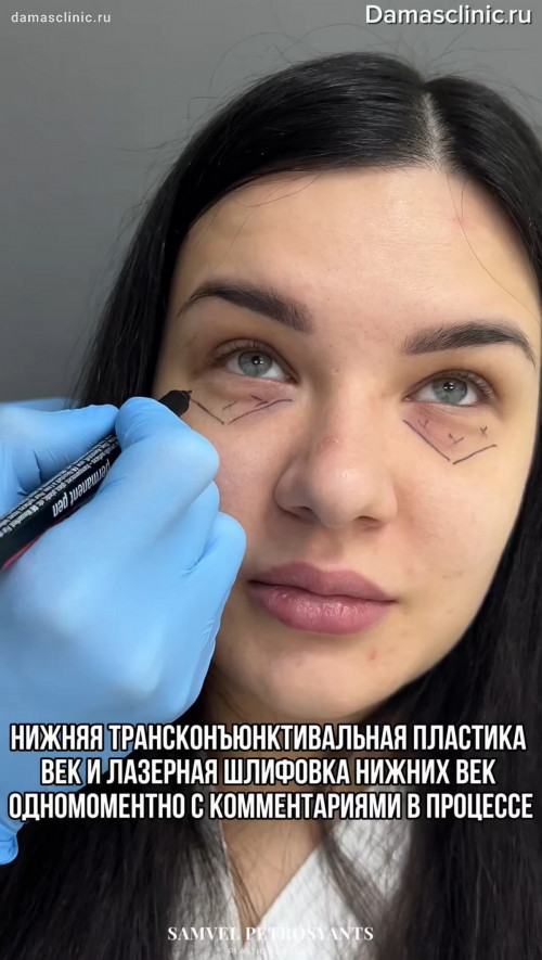 Нижняя трансконъюнктивальная пластика век и лазерная шлифовка нижних век одномоментно с комментариями в процессе с видео