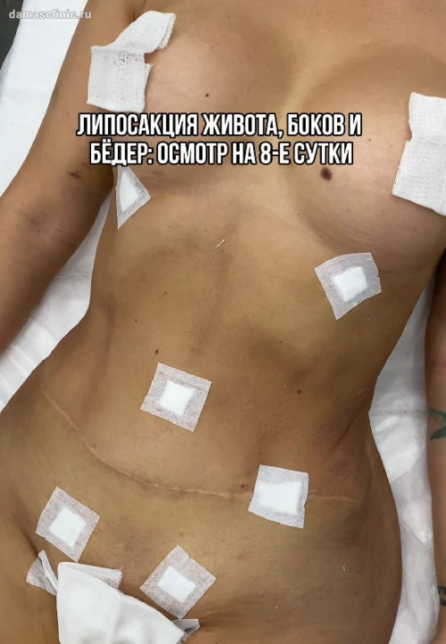 Ультразвуковая VASER / ВЕЙЗЕР-липосакция живота, боков и бедер на 8-е сутки через микропроколы с видео-результатом