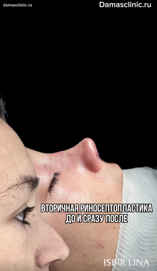 Вторичная риносептопластика до и сразу после с видео-результатом